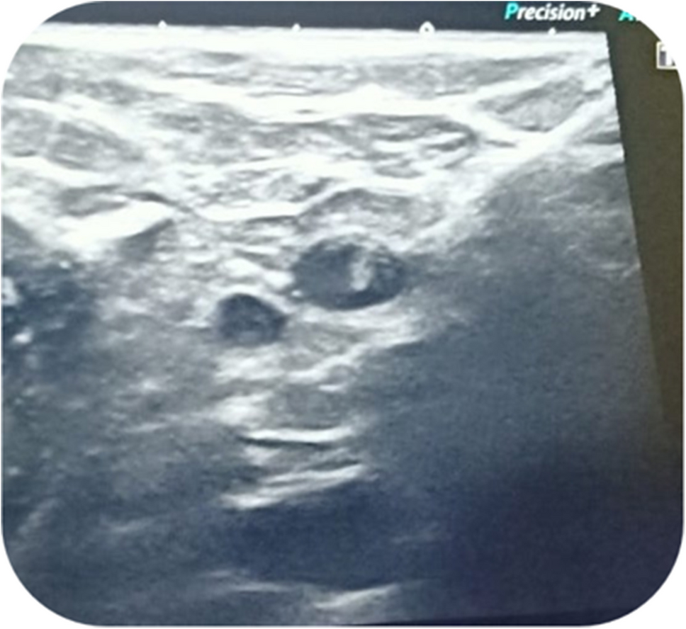 Targeted Axillary Dissection for Clinically Node-Positive Breast Cancer Cases that Turn Negative After Neoadjuvant Systemic Therapy Using Charcoal Tattooing
