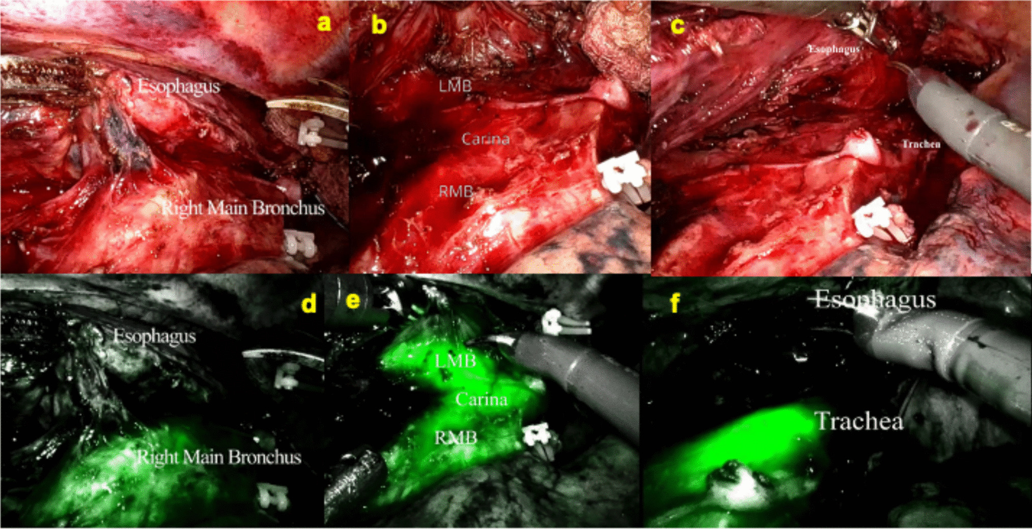Lighting the Way: Green Fluorescence for Safer Airways