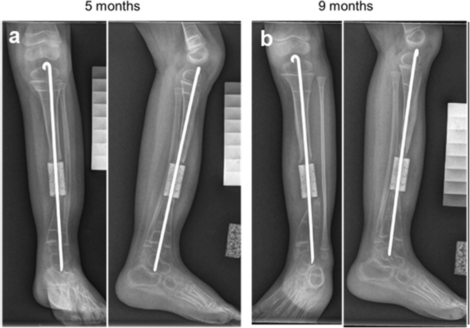 Safety Evaluation of Autologous Human Bone Marrow-derived MSCs on Hydroxyapatite-based Scaffold for Congenital Pseudarthrosis of the Tibia: A Pilot Clinical Trial