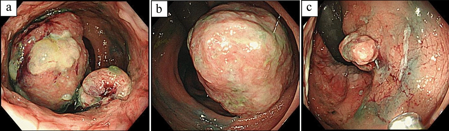 Simultaneous malignant peripheral nerve sheath tumour and malignant melanoma of the anorectal region