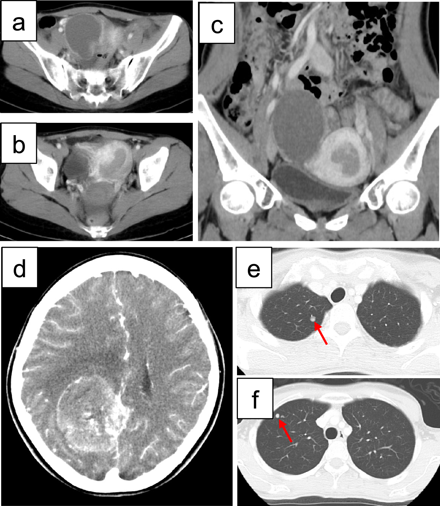 Coexisting germline variants of  and  in a patient with Lynch syndrome who had uterine and ovarian cancer