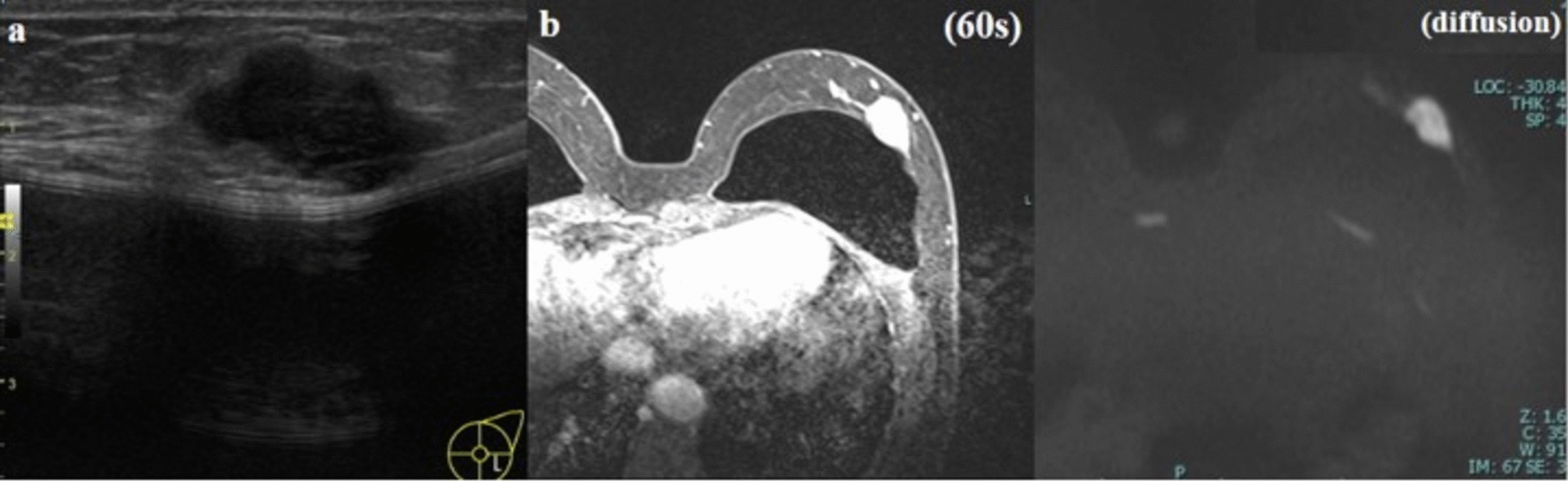 A case of triple-negative breast cancer with thalassemia manifested by anemia progression during neoadjuvant chemotherapy