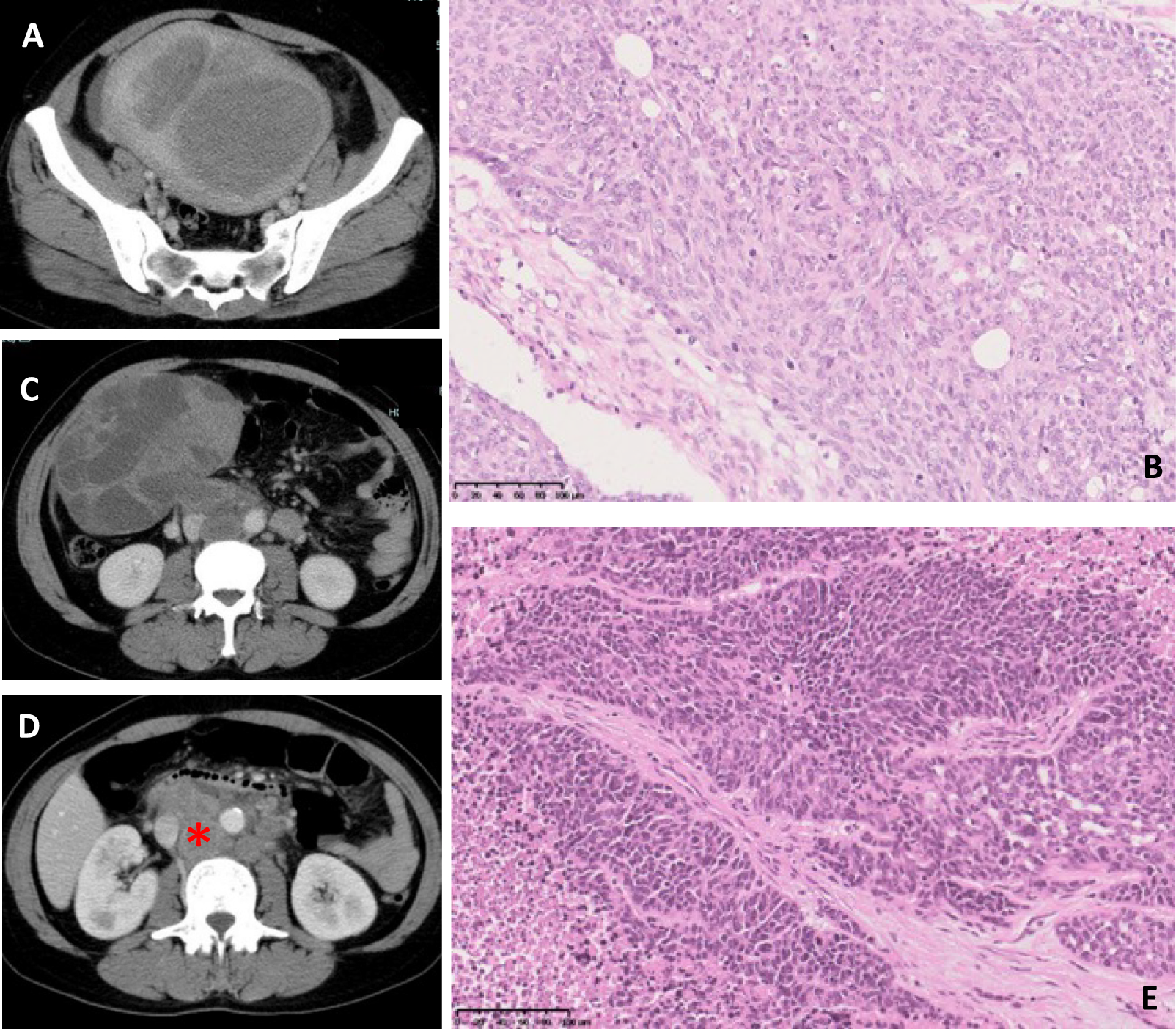 Immune checkpoint inhibitor restores daily function in patient with microsatellite instability (MSI)-high advanced endometrial cancer and poor performance status