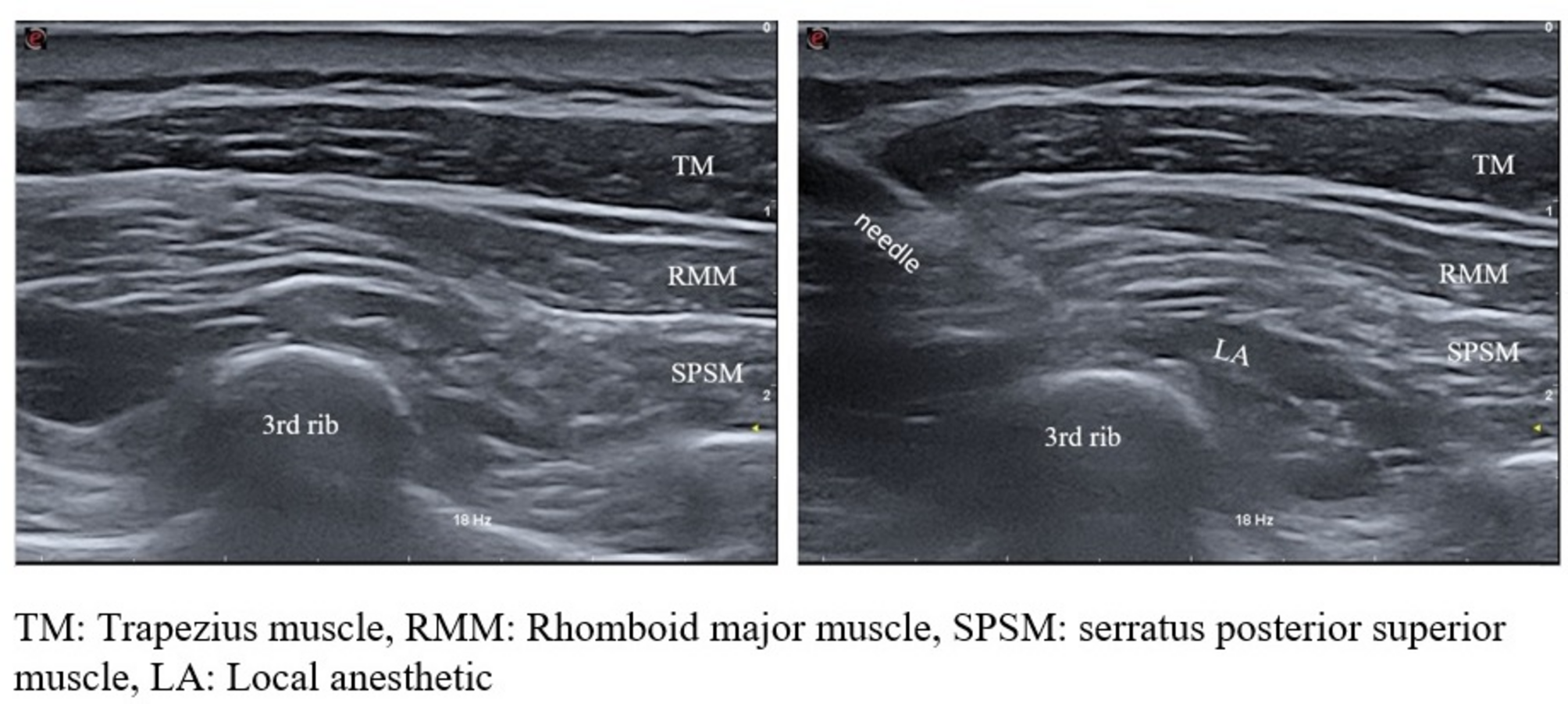 Effects of serratus posterior superior intercostal plane block on postoperative analgesia in patients undergoing breast cancer surgery: a randomized controlled trial