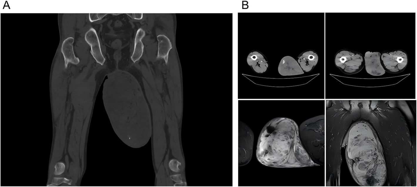 Giant angiomyofibroblastoma of the scrotum: a case report and review of the literature