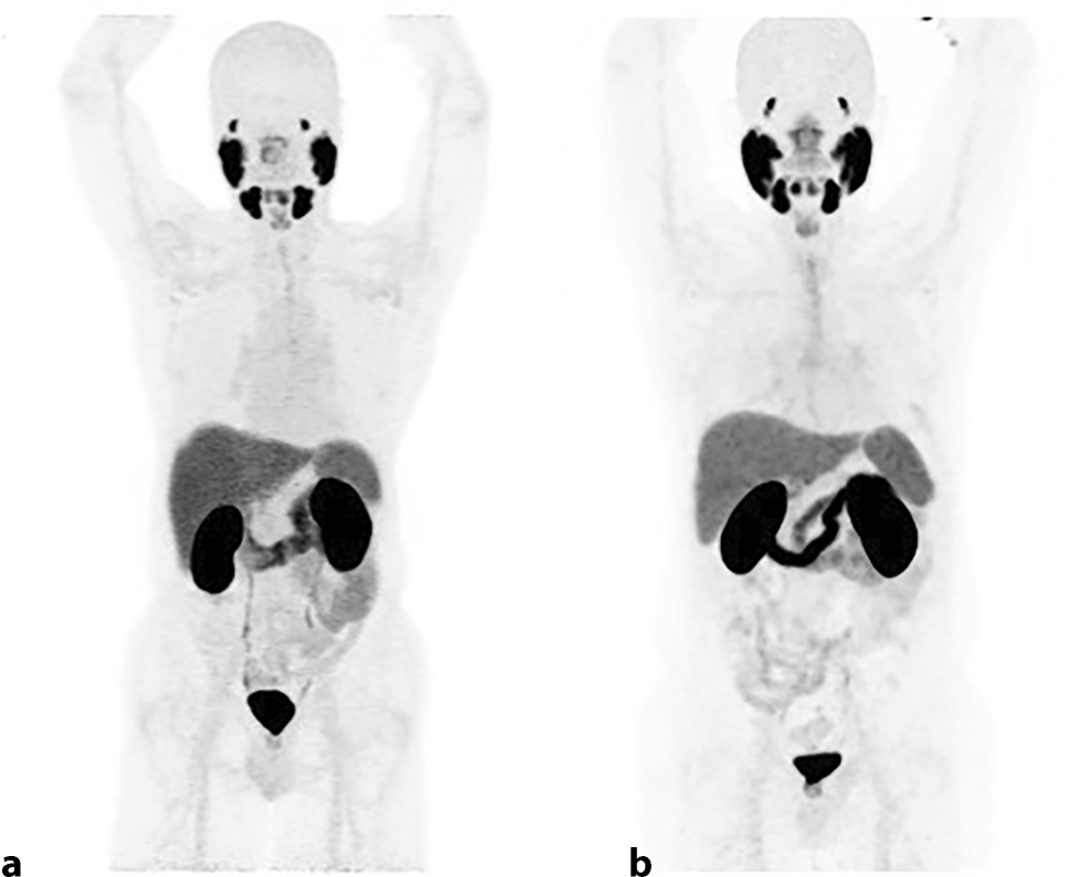 A short review on the current status of PSMA ligands used for PSMA-PET/CT imaging