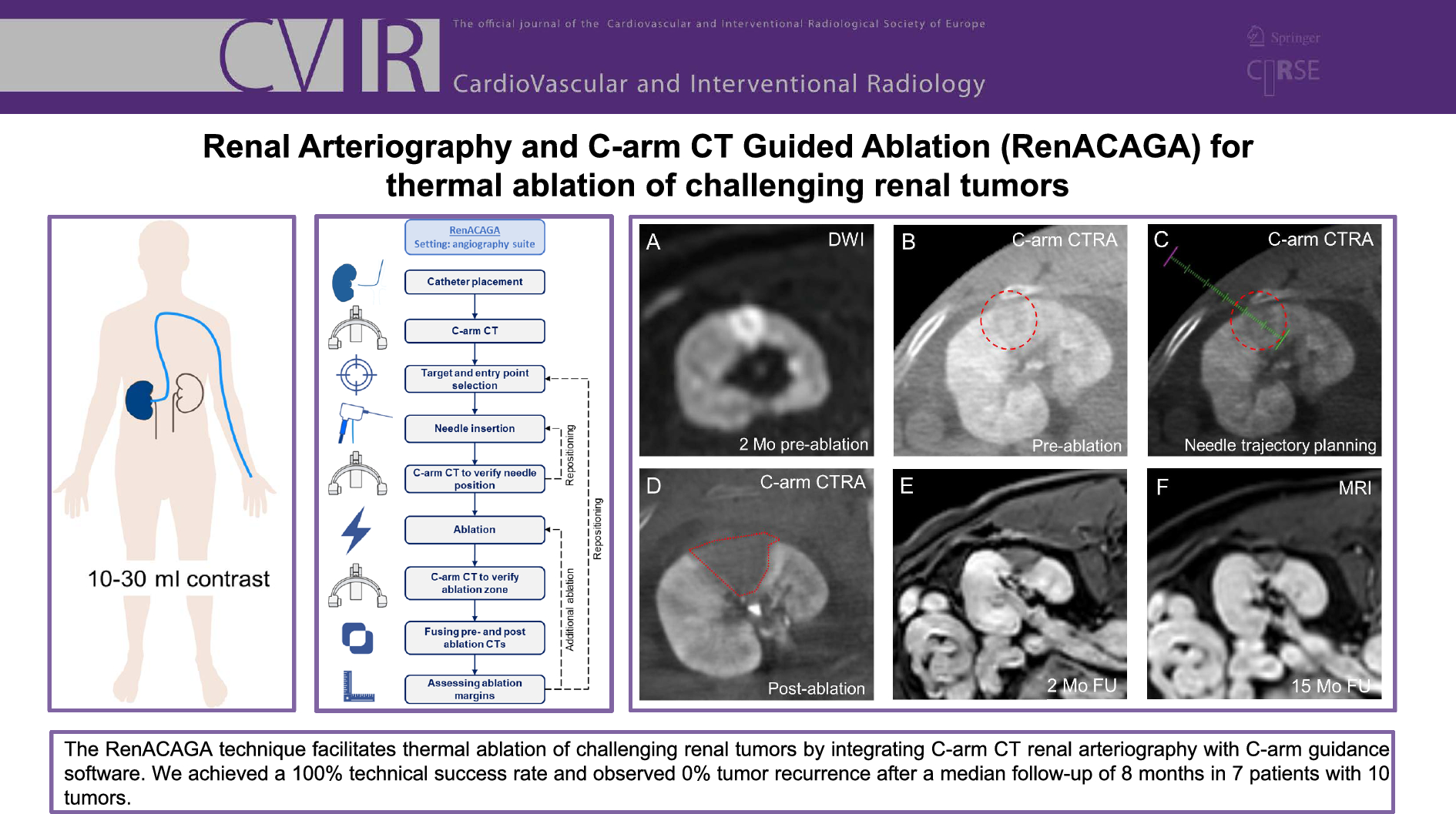 Renal Arteriography and C-arm CT-Guided Ablation (RenACAGA) for Thermal Ablation of Challenging Renal Tumors