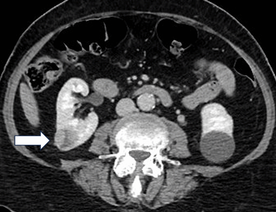 Early Clinical Histotripsy Treatment of Renal Cell Carcinoma