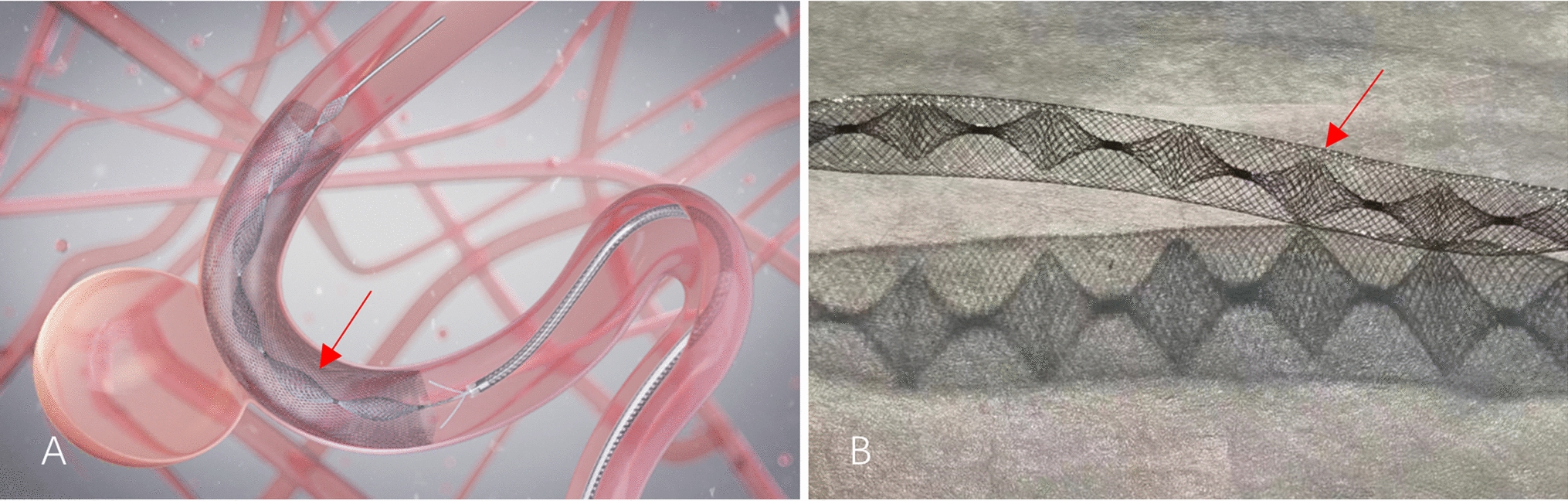 Lattice Flow Diverter for the Treatment of Unruptured Intracranial Aneurysms: A Retrospective Study