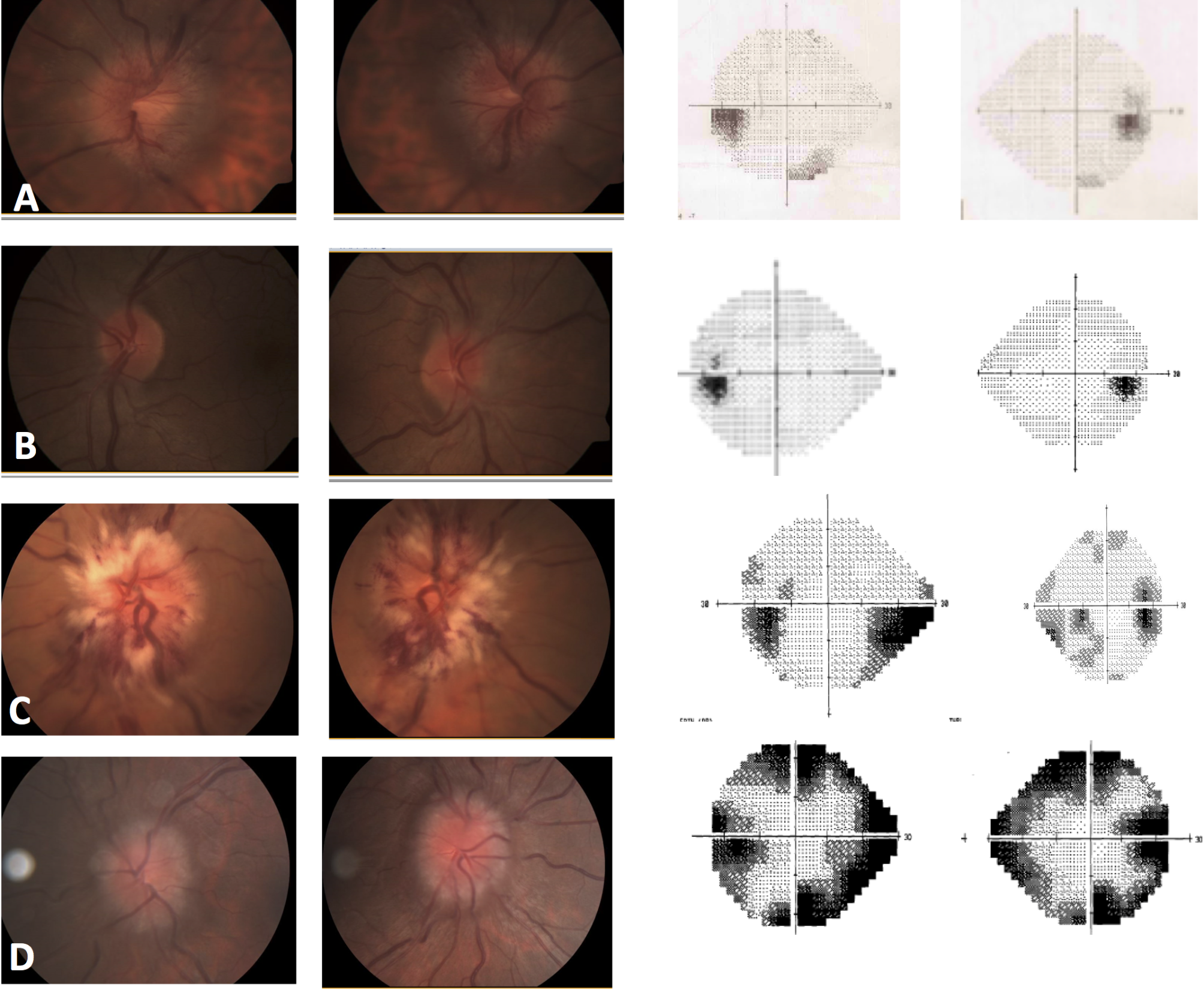 The clinical characteristics, treatment and prognosis differences between occipital brain tumors with venous flow obstruction and occipital brain tumors without venous flow obstruction