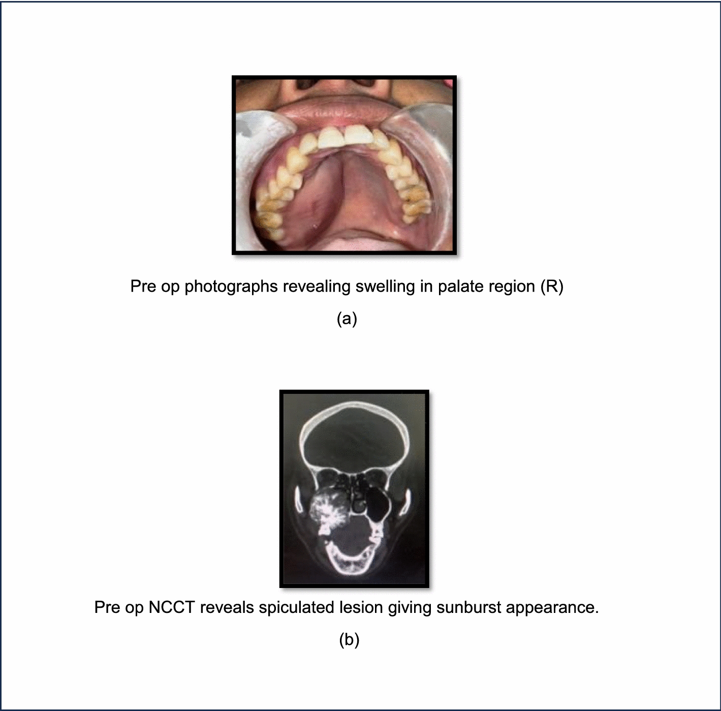 Inflammatory Myofibroblastic Tumor of Maxilla; A Rare Entity to Encounter: from Resection to Rehabilitation—A Case Report with Review of Literature