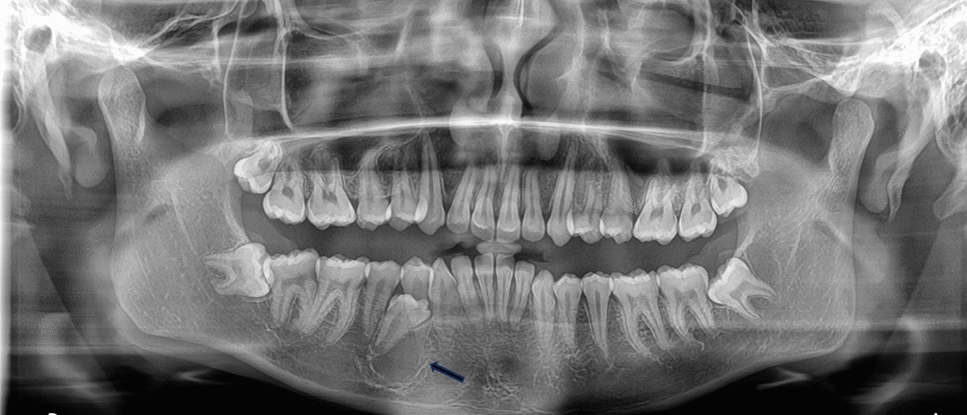 Primordial Odontogenic Tumor Associated with Impacted Supernumerary Tooth: First Case Report and an Updated Review of Literature
