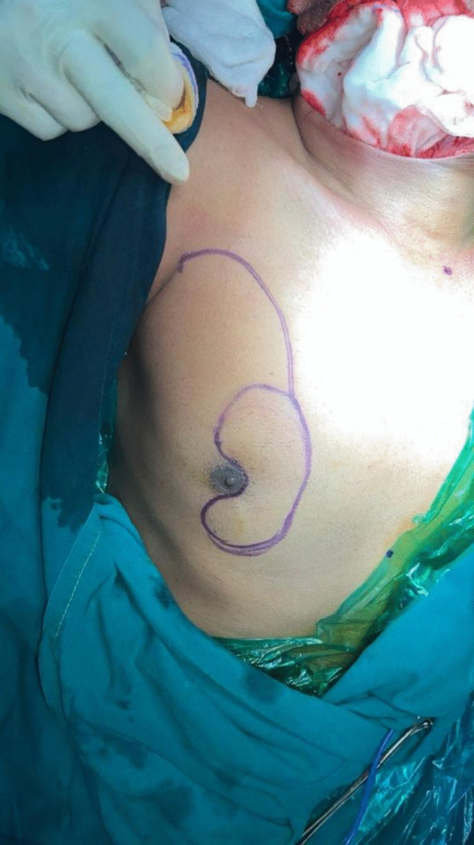 A Kidney-Shaped Innovative Pectoralis Major Myocutaneous (PMMC) Flap for Reconstruction of Bite Resection Defect: A Case Report