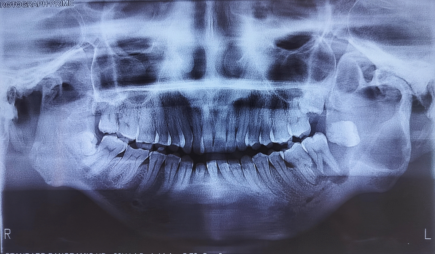 Surgical Challenges in Treating Odontogenic Keratocyst With Bilateral TMJ Ankylosis: A Case Report