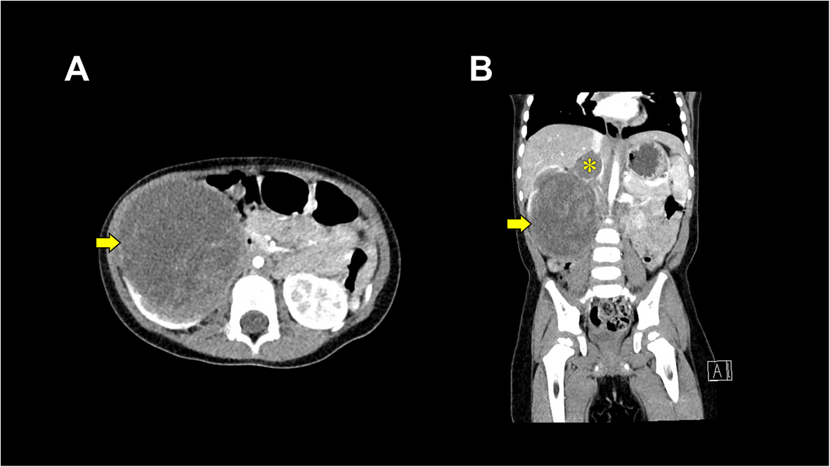 Effective management of acute hemorrhage using an SL One® rapid infusion device in a pediatric patient undergoing nephrectomy for Wilms tumor with inferior vena cava extension: a case report