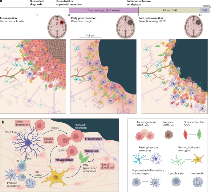 Targeting the glioblastoma resection margin with locoregional nanotechnologies