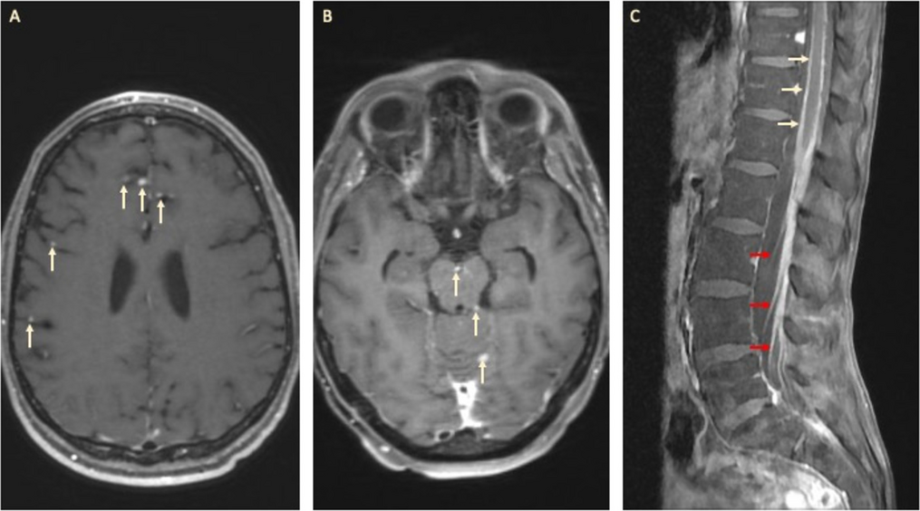 Leptomeningeal Disease: Current Approaches and Future Directions
