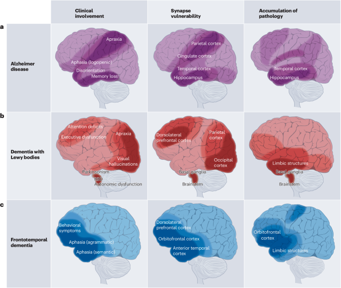 Synapse vulnerability and resilience across the clinical spectrum of dementias