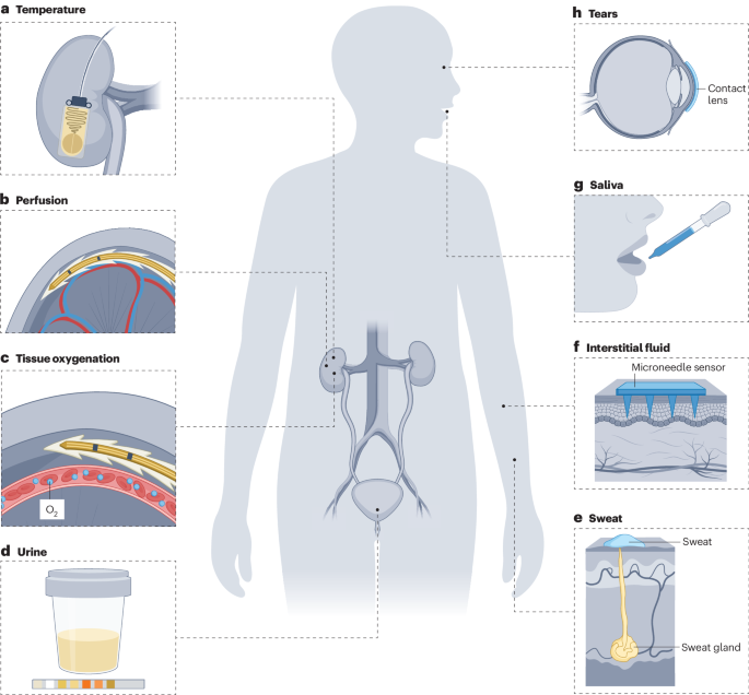 Implantable bioelectronics and wearable sensors for kidney health and disease