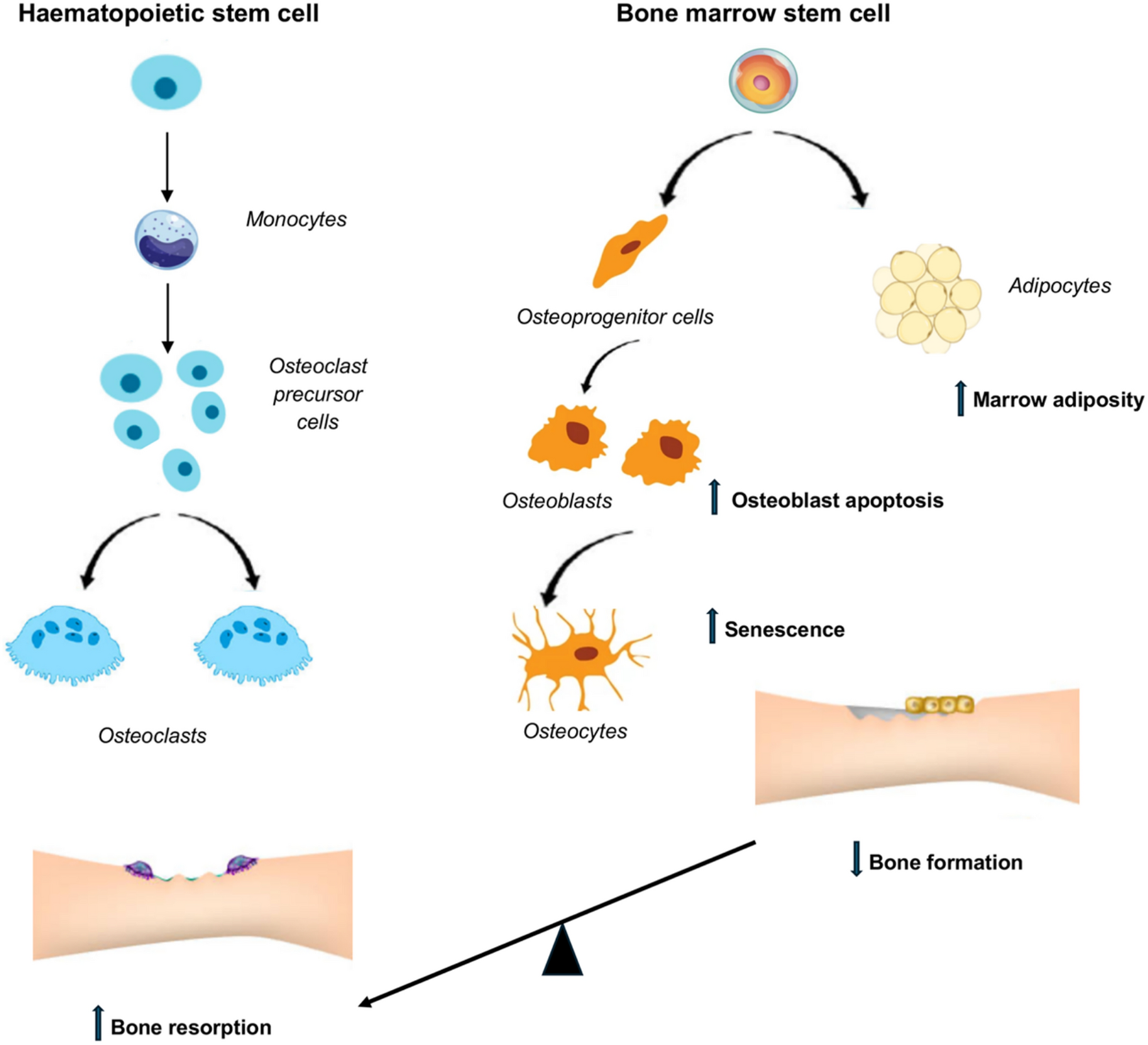 Treatment Considerations for Severe Osteoporosis in Older Adults