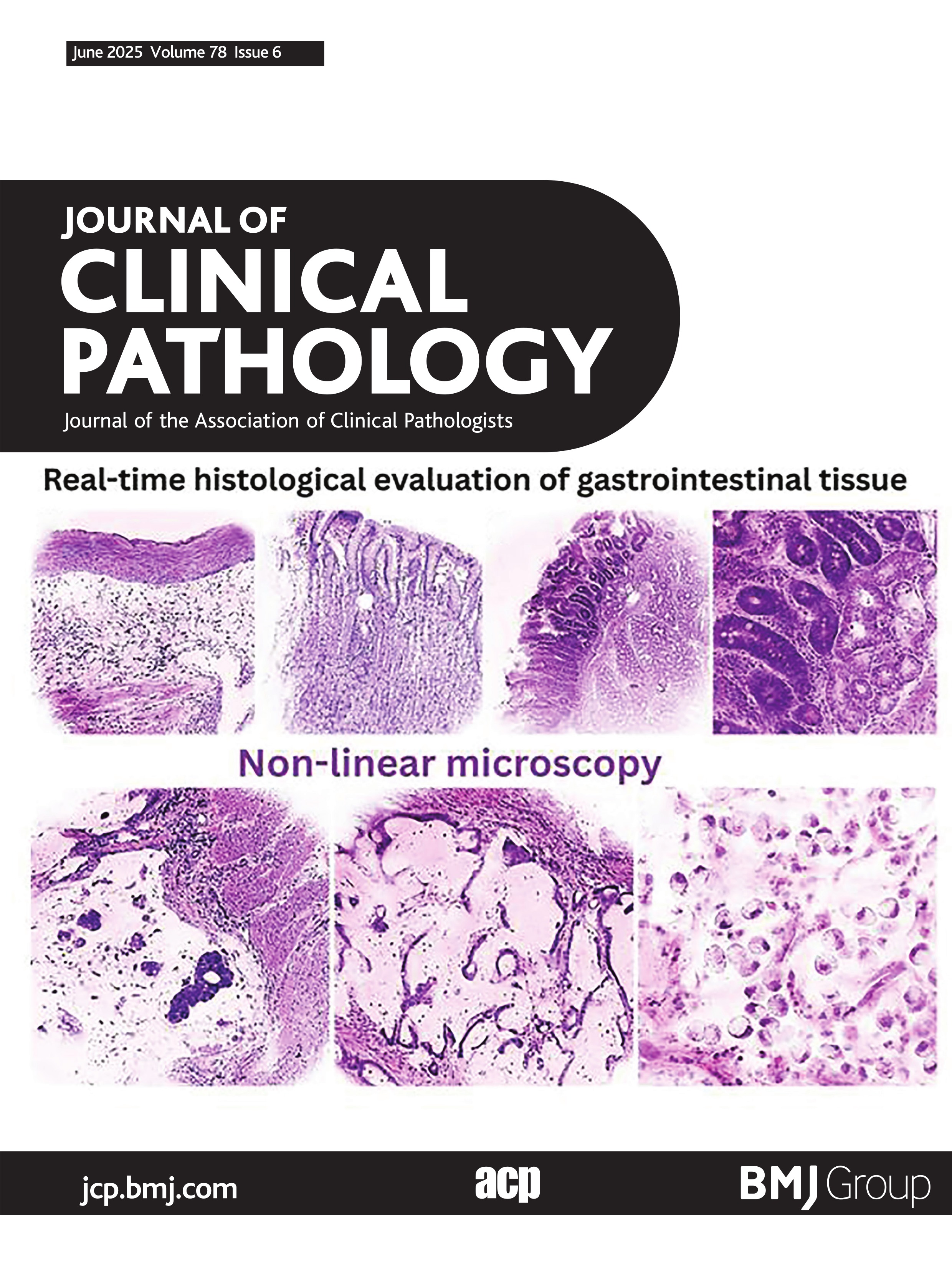 Computational pathology identifies a low B-cell content in the tumour microenvironment as a predictor of adverse outcome in patients with classic Hodgkin lymphoma treated with ABVD