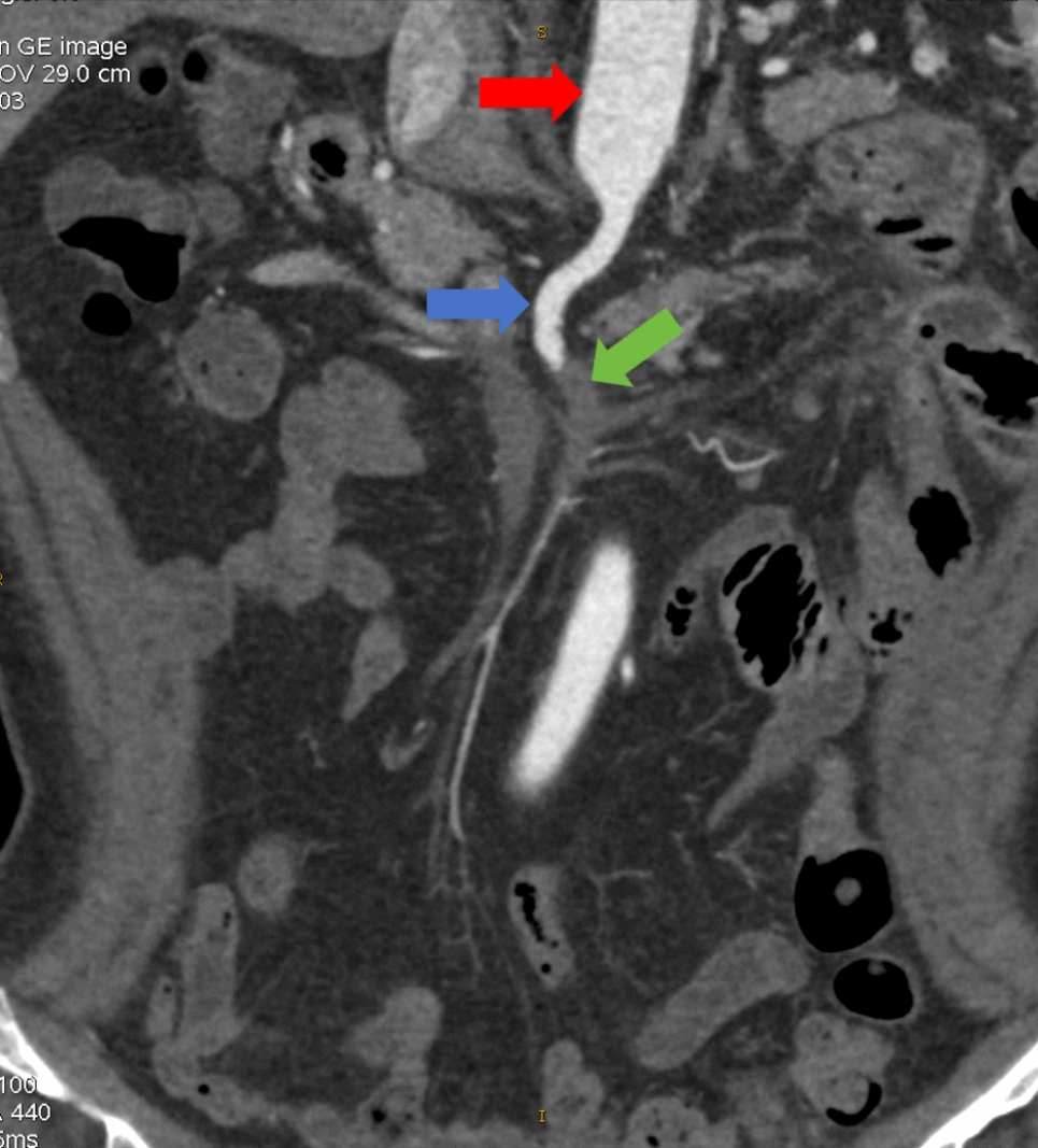 A Rare Cause of Recurrent Intestinal Ischemia: Isolated Superior Mesenteric Artery Dissection