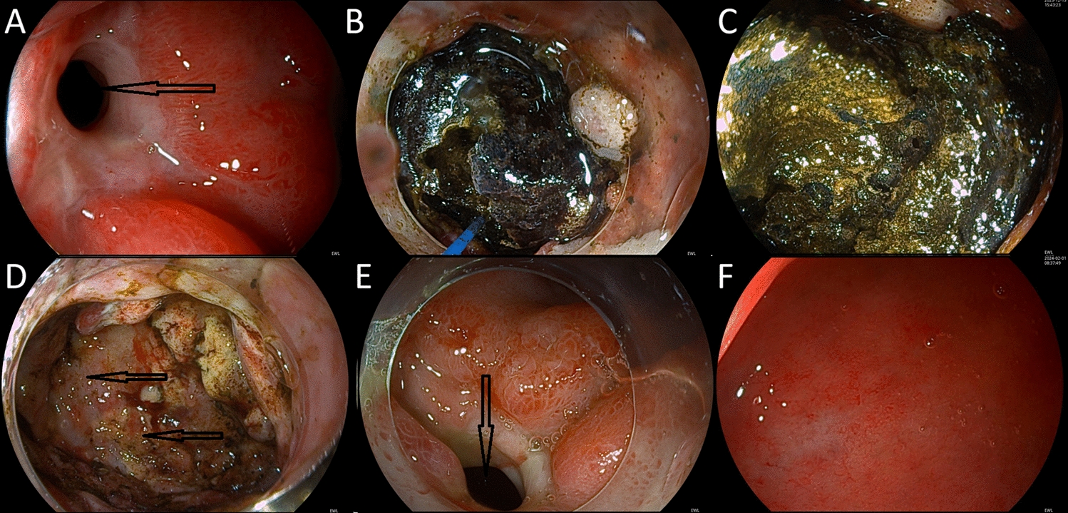 Lithotripsy over the Cholecystoduodenal Fistula: A Video Vignette