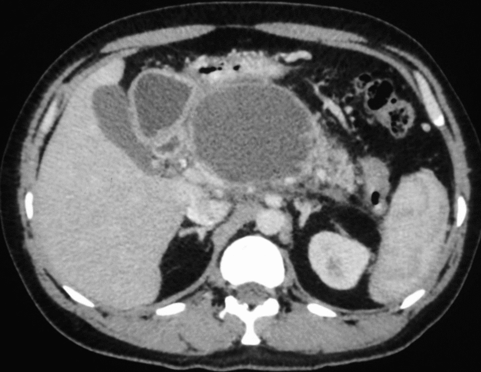 Masked Vessel Triggering a Catastrophic Bleed During EUS-Guided Cystogastrostomy
