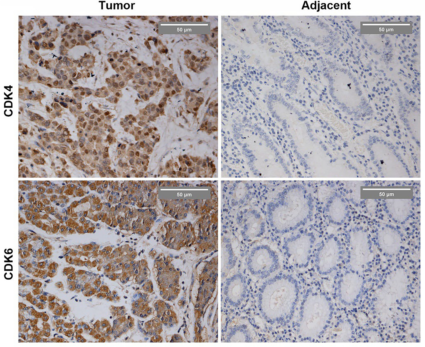 Association Between CDK4/CDK6 Expression and Prognosis in Patients with Adenocarcinoma of Gastroesophageal Junction