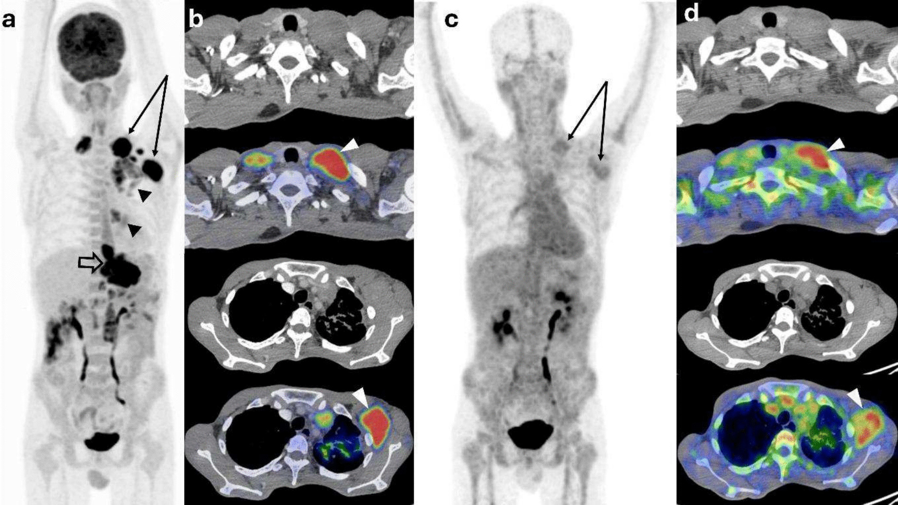 Diagnostic Accuracy of [Ga]GaNOTA-Ubiquicidin PET-CT for Differentiating Infections from Cancer in Oncology Practice: Preliminary Results from a Pilot Study