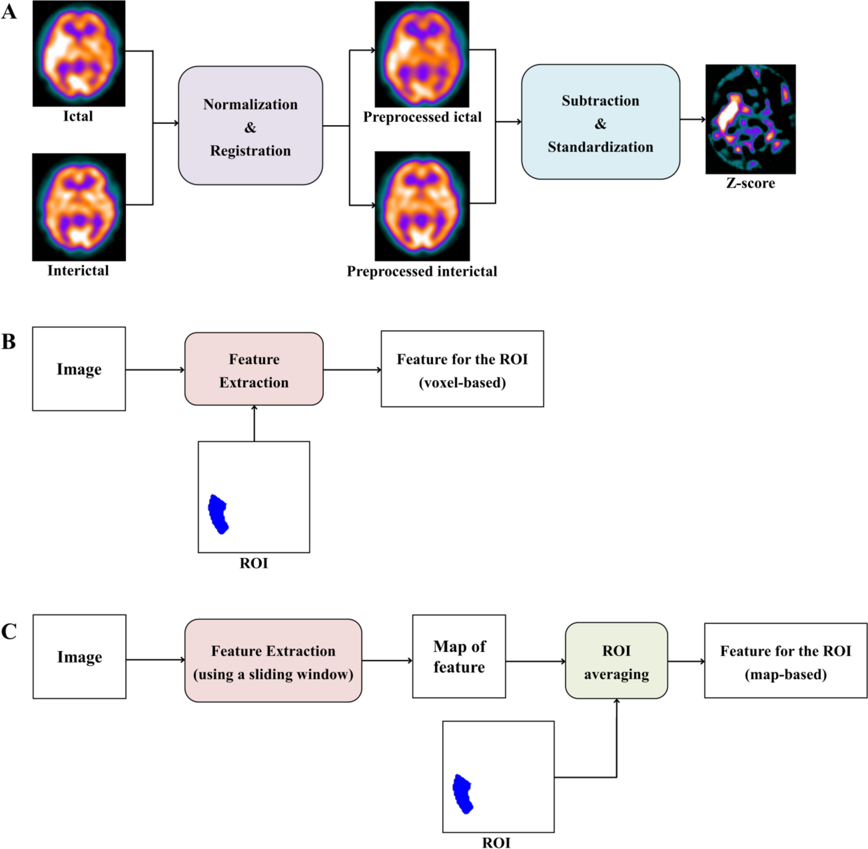 Epileptogenic Zone Localization from SPECT Imaging Using Radiomics