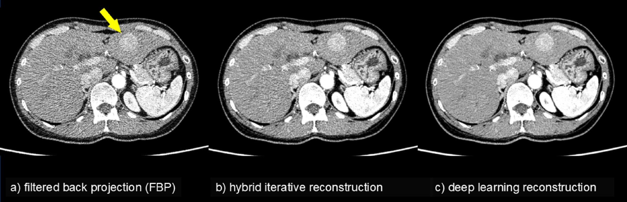 Artificial intelligence in imaging diagnosis of liver tumors: current status and future prospects