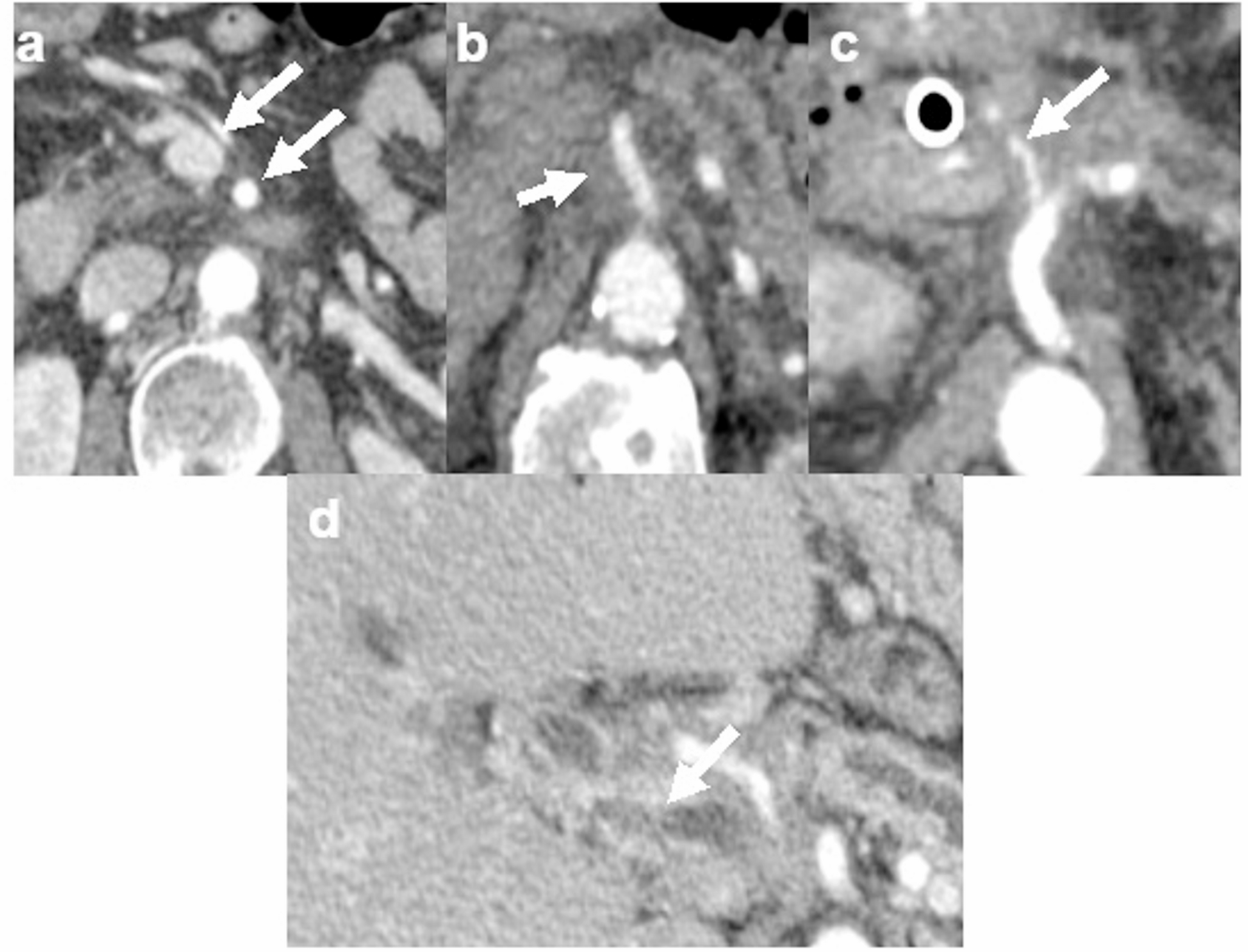 CT imaging findings following treatment with combination SBRT and chemotherapy versus stand-alone chemotherapy for locally advanced pancreatic adenocarcinoma