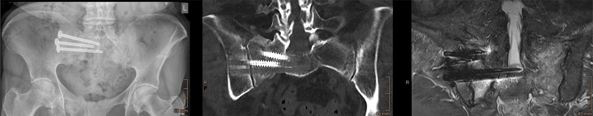 Unilateral sacral fragility fractures: a comparative study of unilateral vs. bilateral minimally invasive osteosynthesis