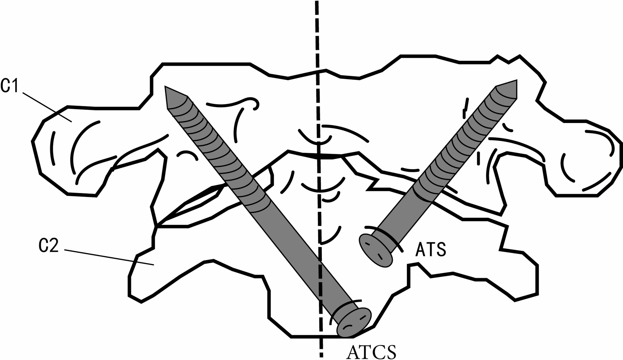 Anterior transarticular crossing screw fixation for reducible atlantoaxial dislocation with basilar invagination: a radiological feasibility study