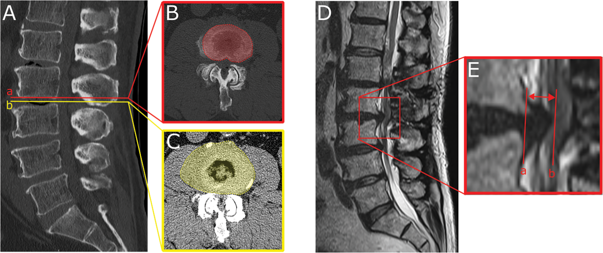 Disc bulging predicts poor outcomes of decompression surgery for lumbar spinal canal stenosis