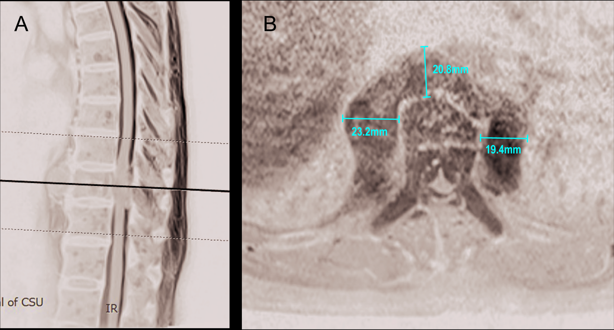 Incidence and risk factors investigation of chylous leakage following thoracic or lumbar vertebrectomy: a single‑center, retrospective analysis of 545 patients