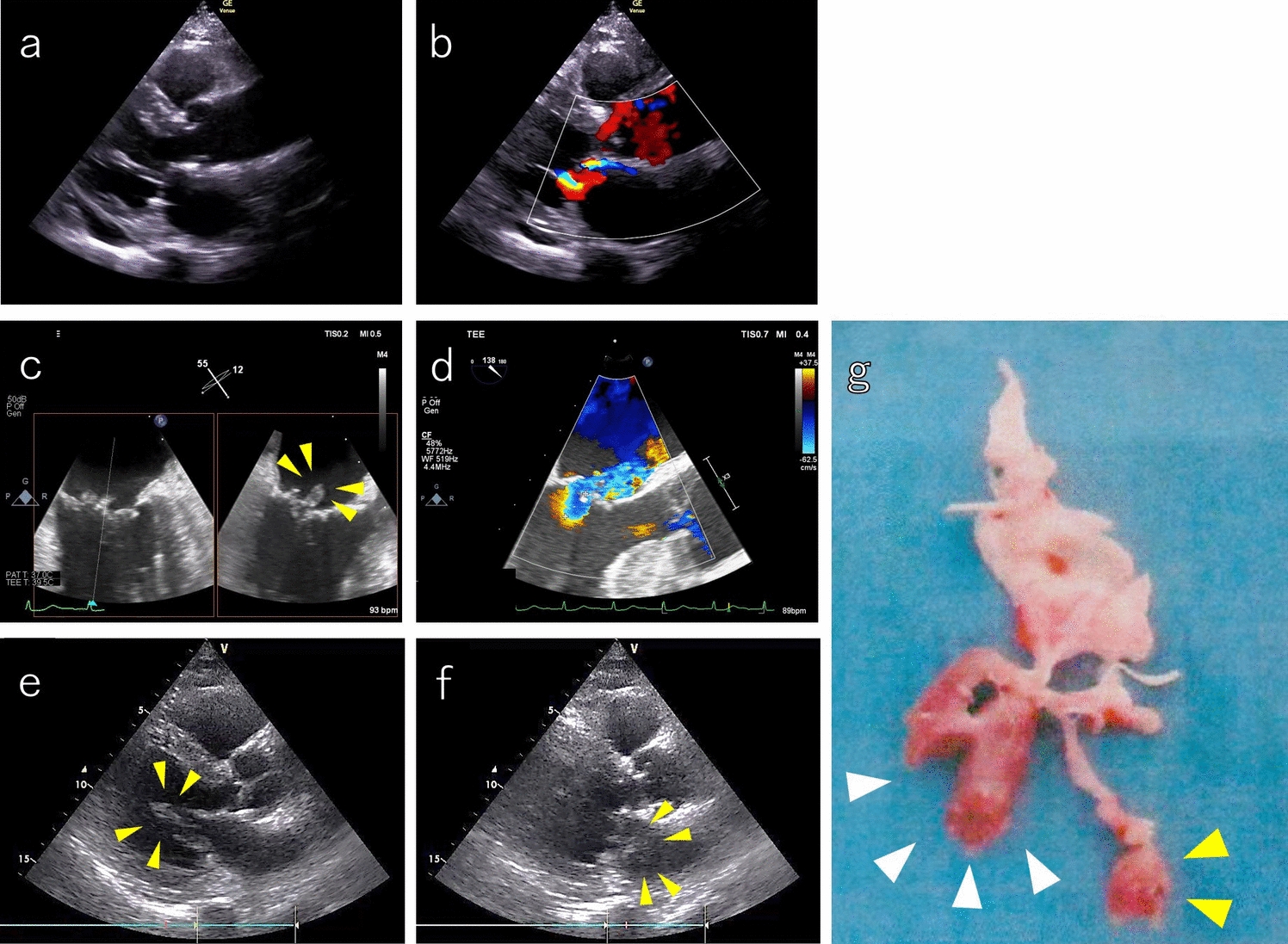 Larger papillary muscle rupture following small partial papillary muscle rupture after myocardial infarction