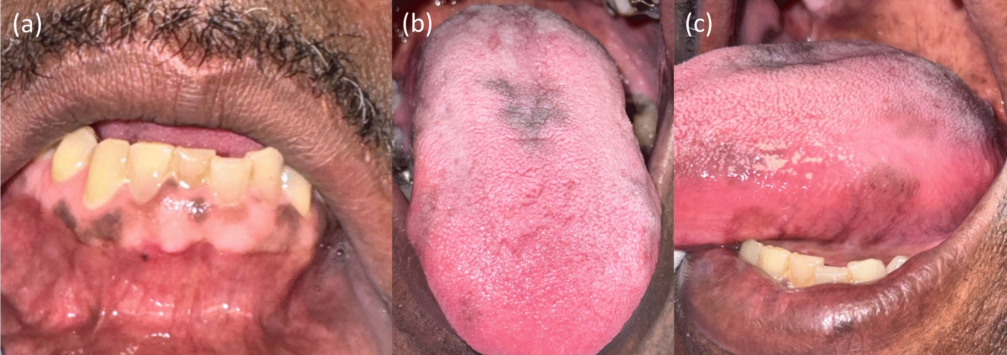 Pigmented Lesions of the Oral Mucosa: Clinical Presentation, Histology, and Recommendations for Management
