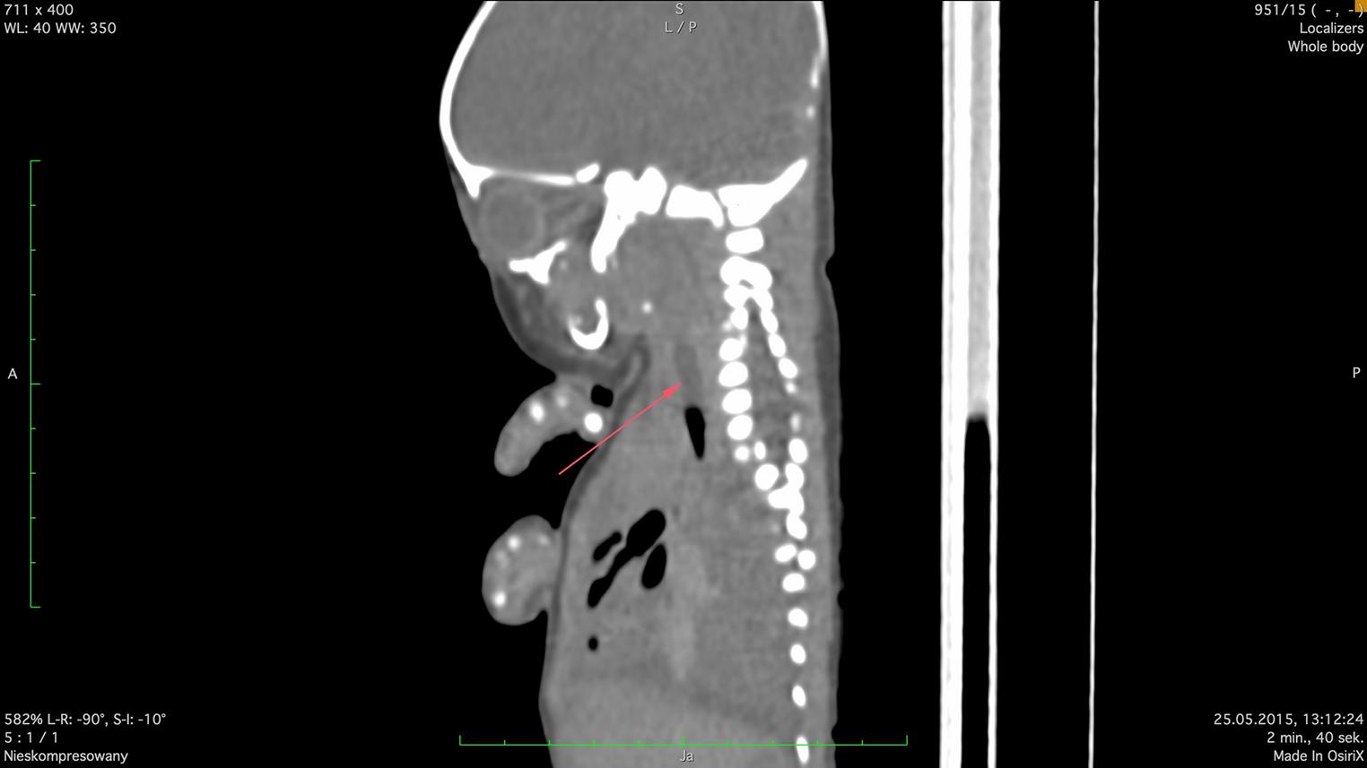 Usefulness of postmortem computed tomography when neonatal death occurred after fetoscopic endotracheal occlusion– case report