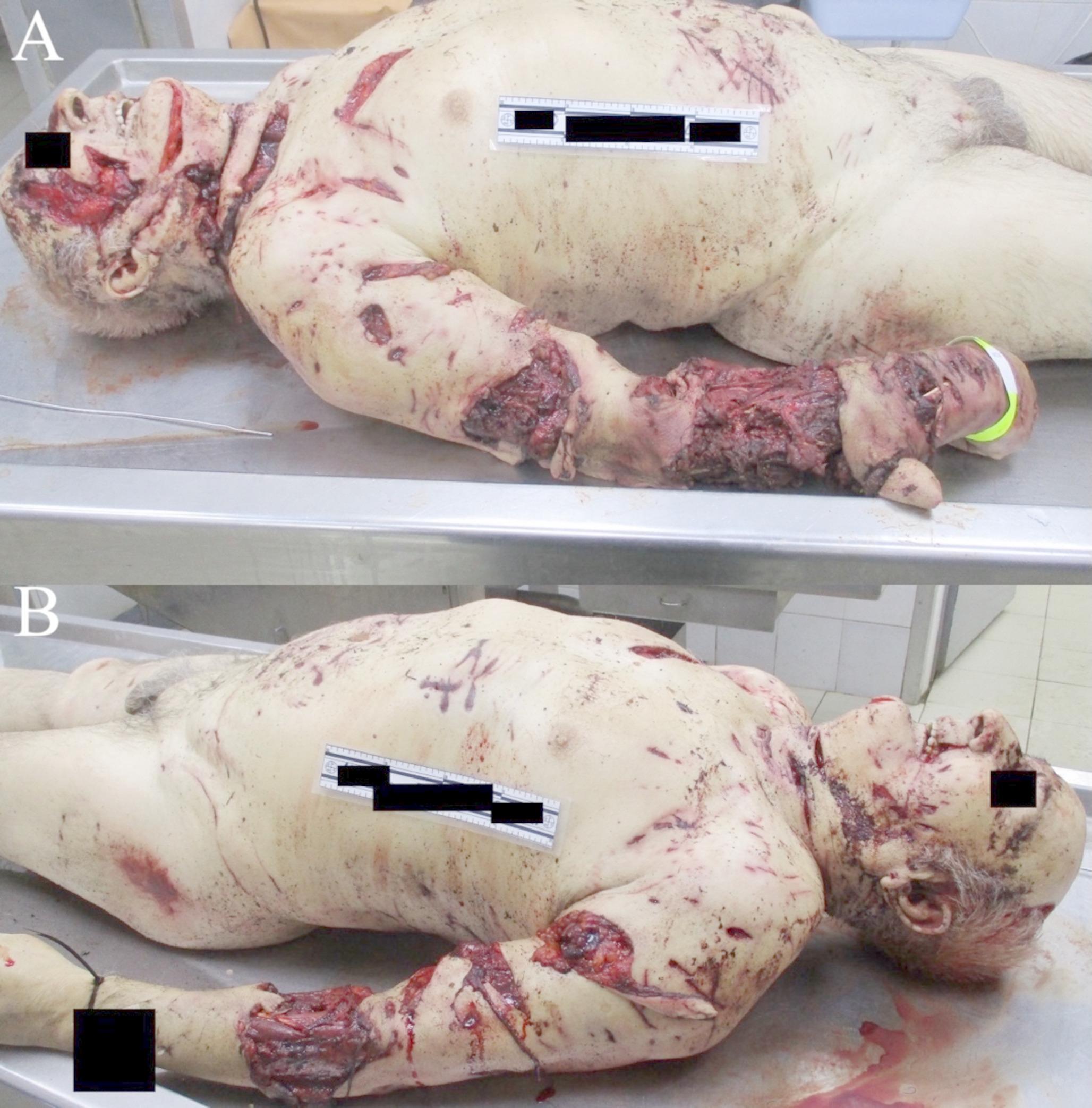 Fatal stray dog attack in Russian Federation: a case report based on CCTV documentation