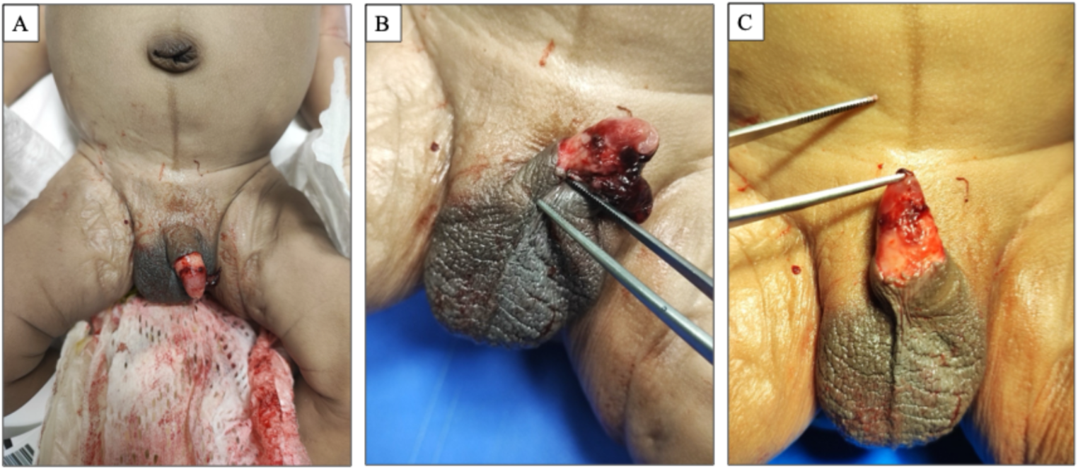Neonatal fatal haemorrhage after a ritual circumcision: forensic and ethical considerations