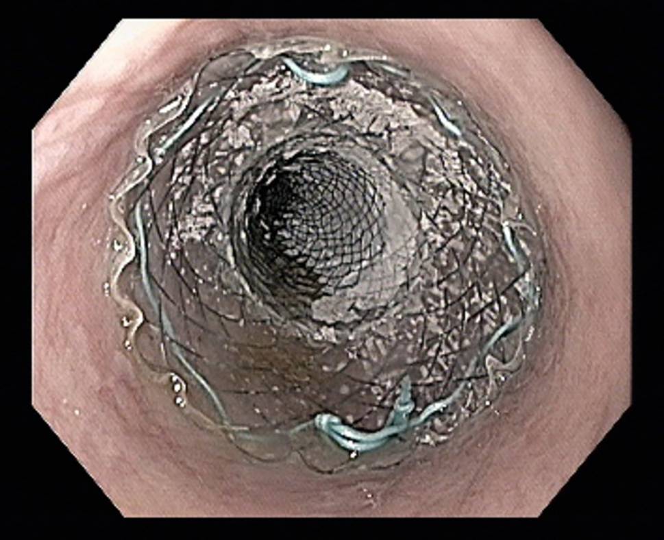 Austrian Society of Surgical Oncology consensus paper on the classification and treatment of anastomotic leaks after esophageal resections