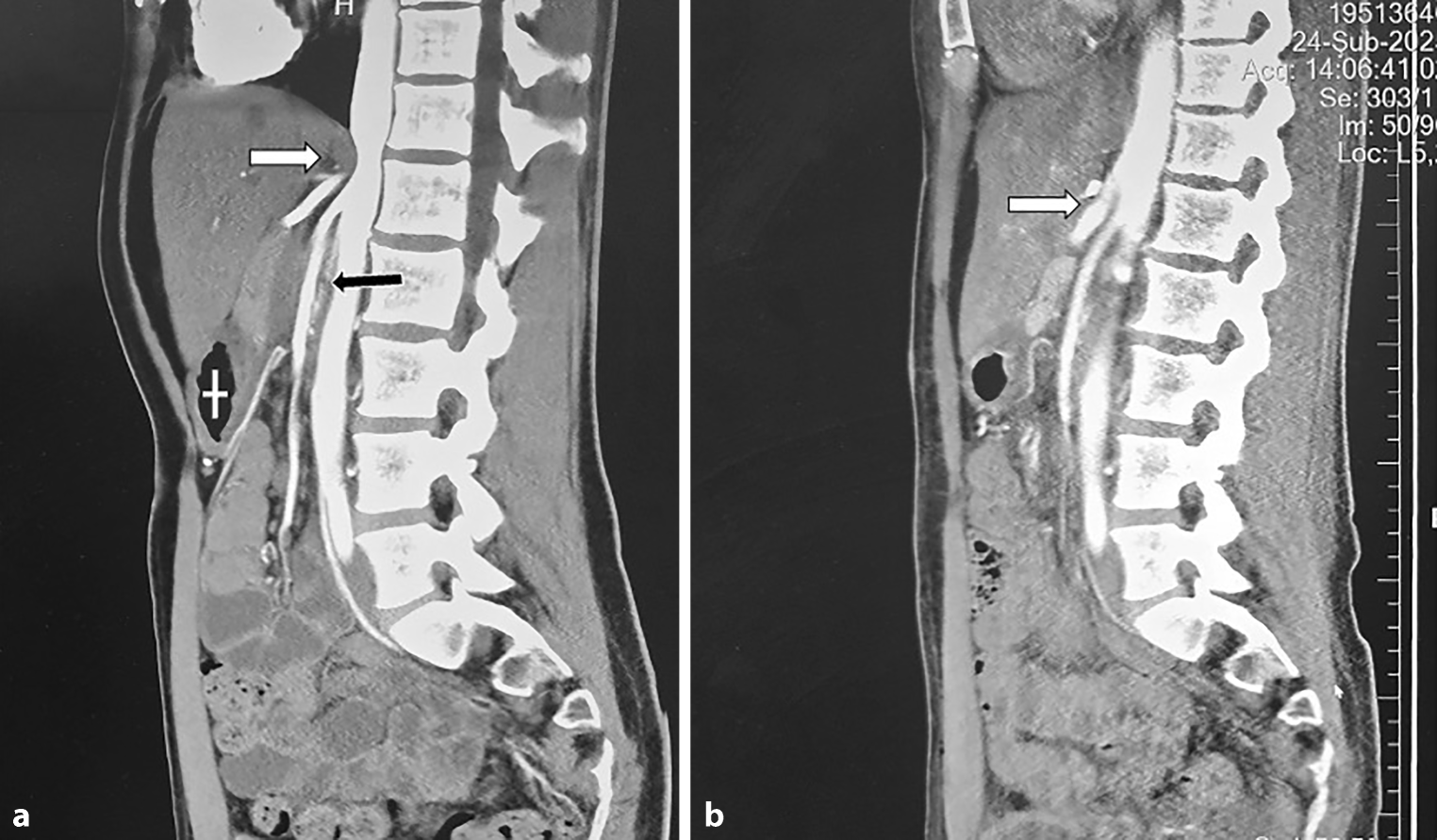 Simultaneous laparoscopic median arcuate ligament release and duodenojejunostomy for treatment of concurrent MALS and SMAS: a novel classification and surgical approach