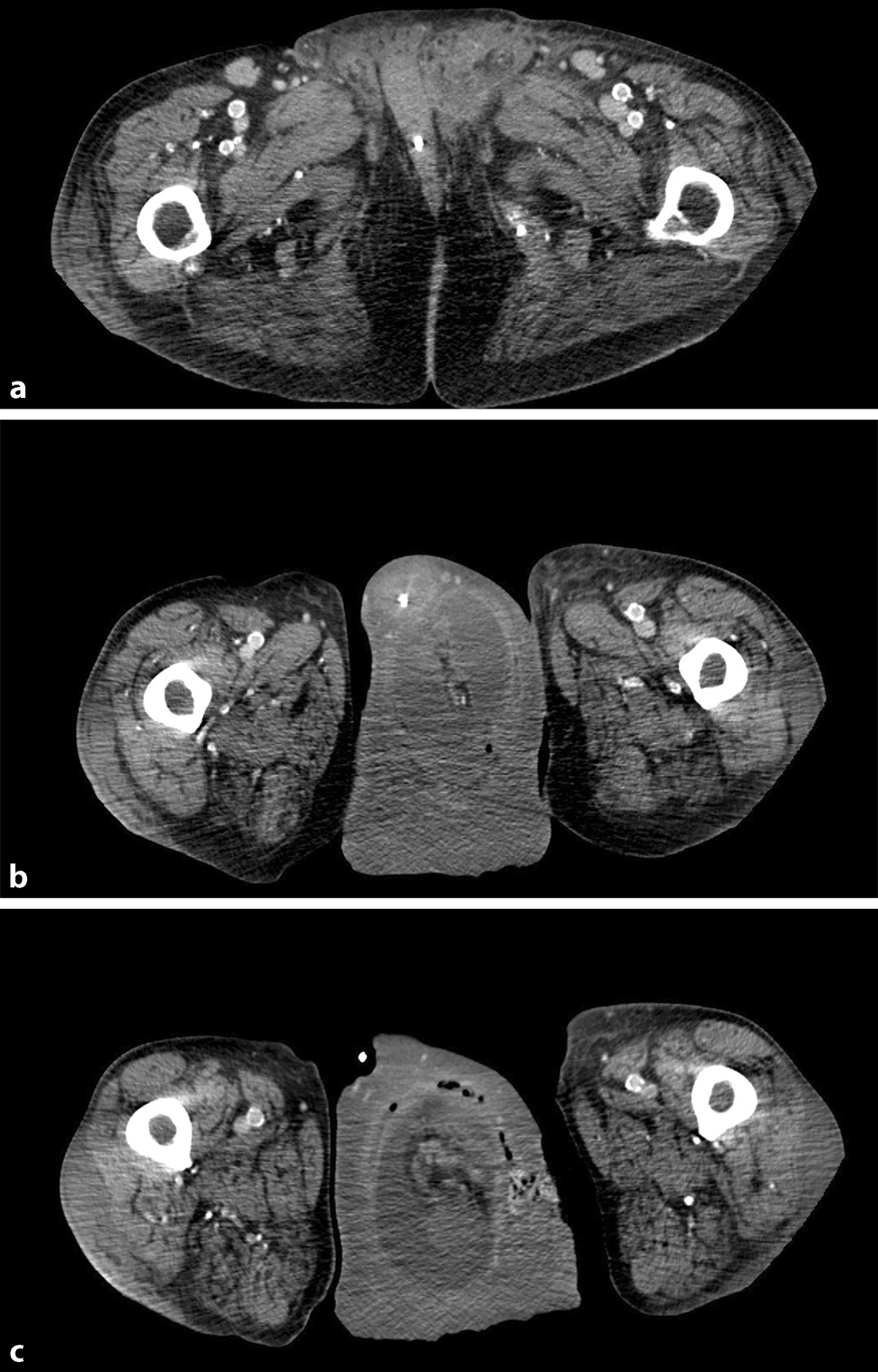 Is there a role for botulinum toxin in inguinal hernia surgery? Case report on the management of a giant scrotal hernia
