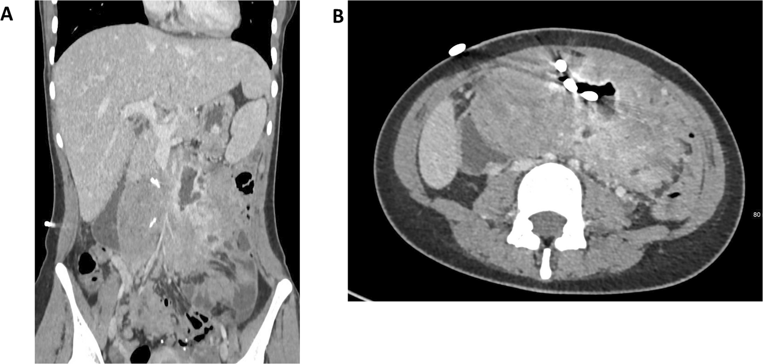 Intestinal transplantation in Familial Adenomatous Polyposis