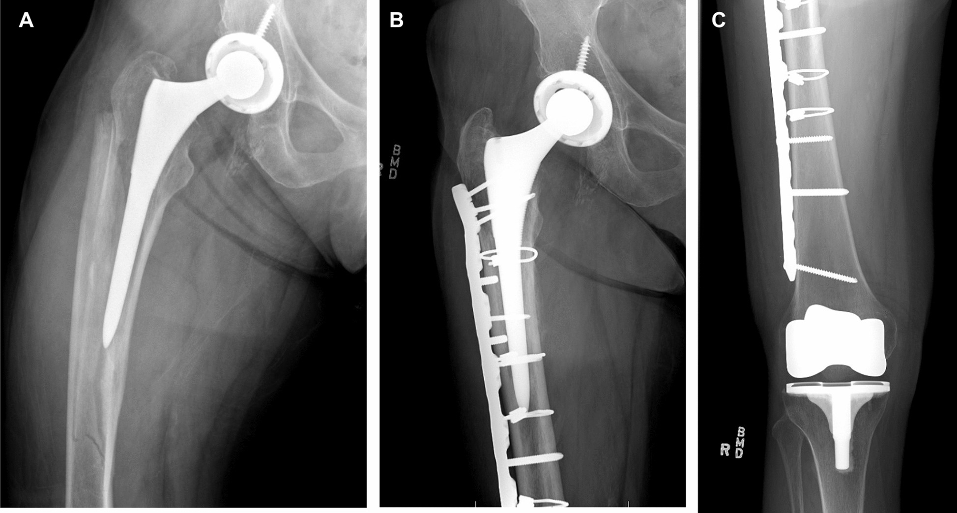 The Role of Osteoporosis in Total Hip Arthroplasty Periprosthetic Fractures and Current Management Strategies: a Review