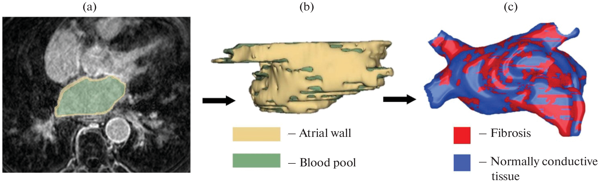 Patient-Centered Computer Model Comparing Excitation Conduction in Normal and Long-Term Persistence of Atrial Fibrillation