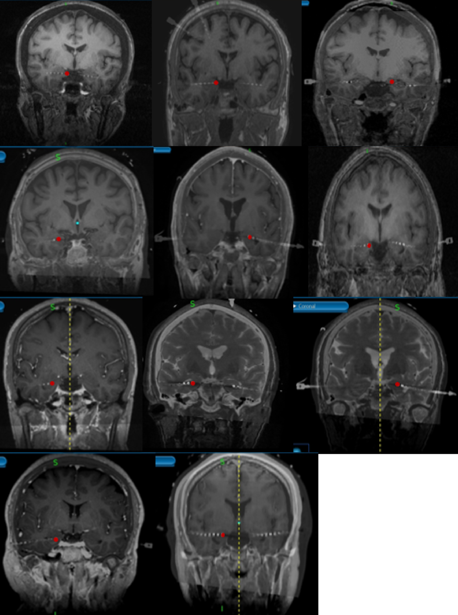 Beta-band desynchronization in the human hippocampus during movement preparation in a delayed reach task