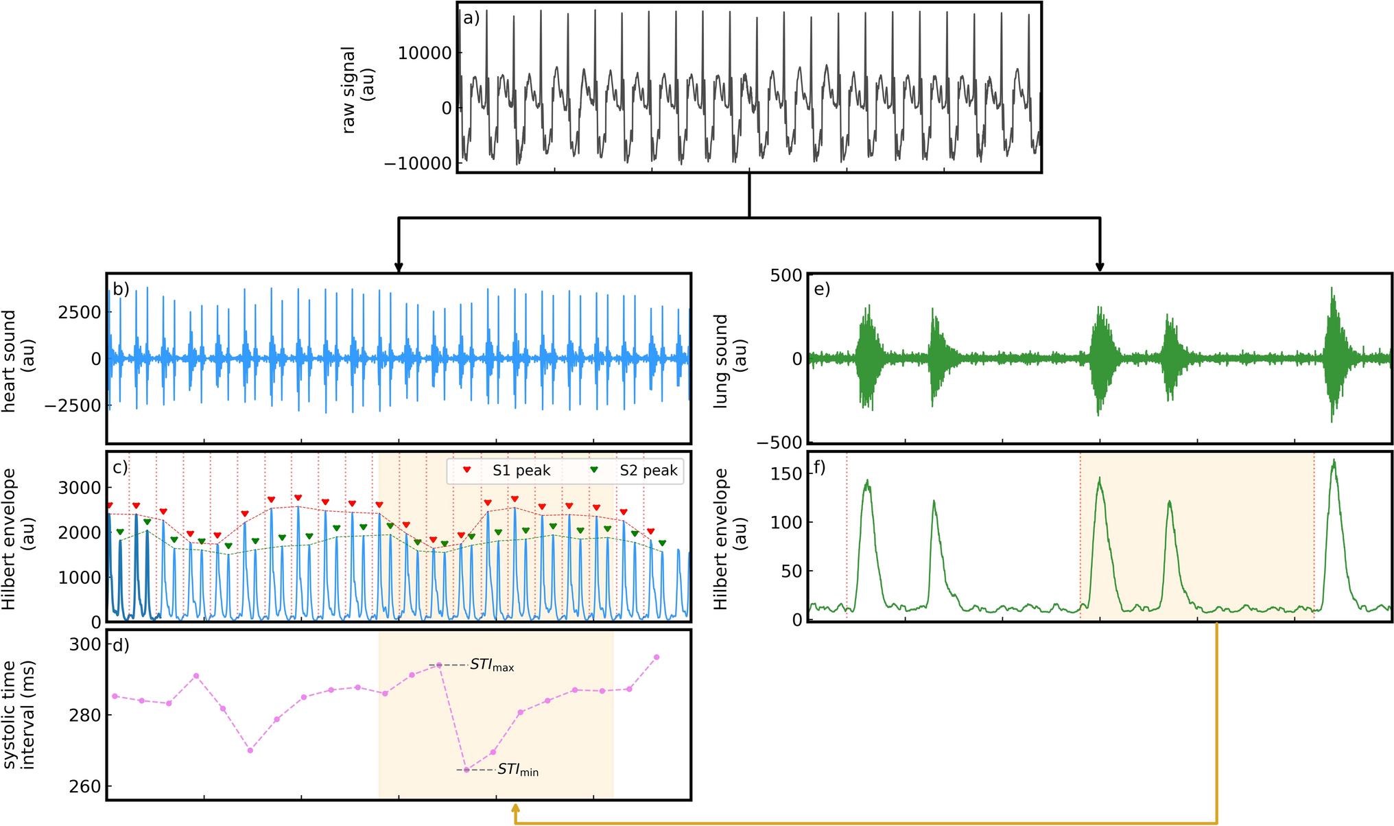 Unobtrusive continuous hemodynamic monitoring method using processed heart sound signals in patients undergoing surgery: a proof of concept study